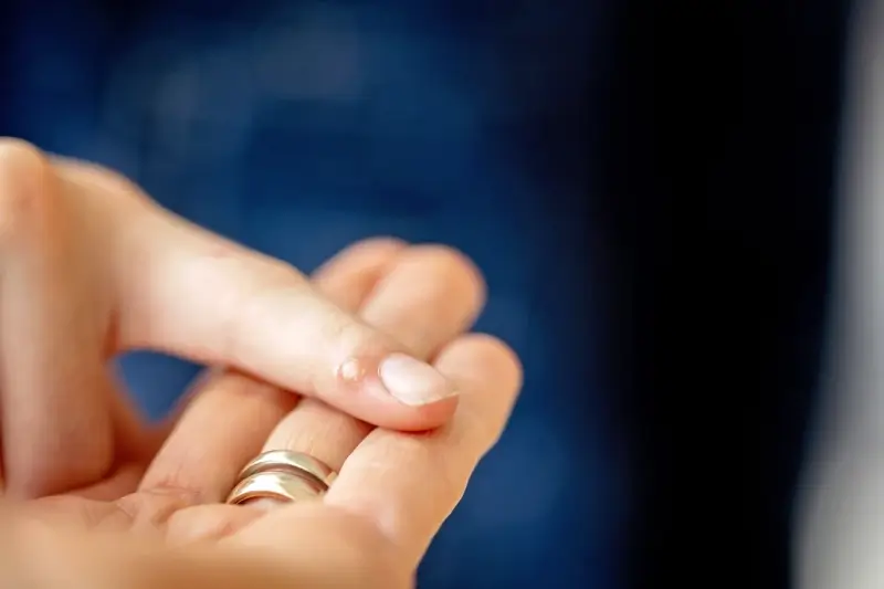 Co jest dobre na kurzajki dla dzieci?